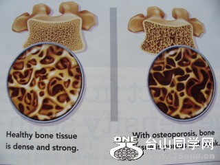 osteoporosis 1.jpg